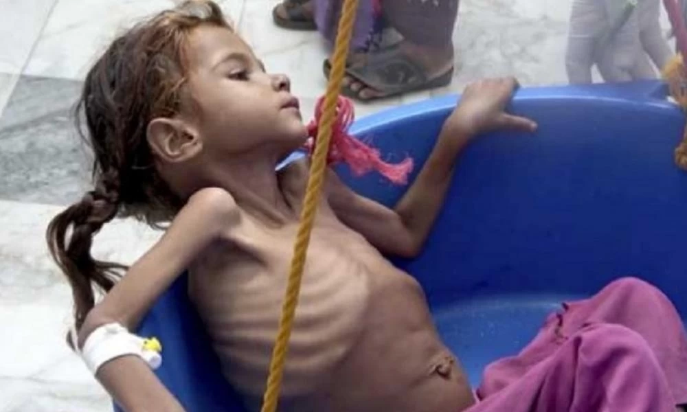 UNICEF: Λόγω του κορονοϊού ακόμη 7 εκατομμύρια παιδιά κινδυνεύουν με υποσιτισμό